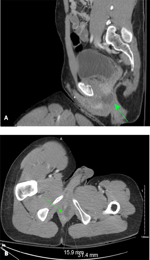 Contrast-enhanced CT chest/abdomen/pelvis during a tier 2 trauma activation, revealing a homogenous hypodense perianal fluid collection from sagittal (A) and transverse (B) planes.