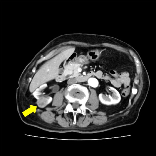 CT showing 30 mm right renal cell carcinoma. The arrow shows the tumor.