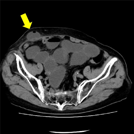 CT showing small intestine penetrating fascia of rectus abdominis. The arrow shows the incarcerated small intestine.