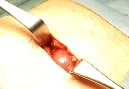 Small intestine incarcerated in the fascia of rectus abdominis.