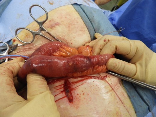 Slightly discolored small intestine.