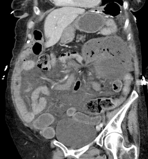 Computed tomography showing cecal volvulus secondary to internal hernia.