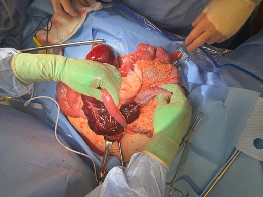 Cecal volvulus through Petersen’s defect.