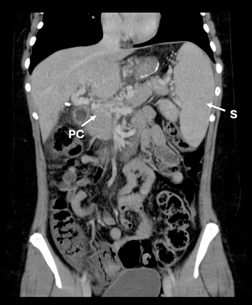 CT scan showing portal cavernomatosis and massive splenomegaly. PC, portal cavernomatosis; S, splenomegaly.
