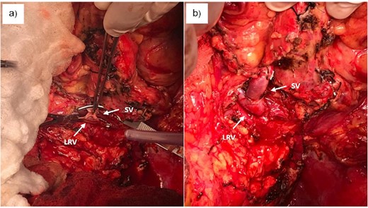 (a) Creation of proximal splenorenal shunt between clamps. (b) Proximal splenorenal shunt. SV, splenic vein; LRV, left renal vein.