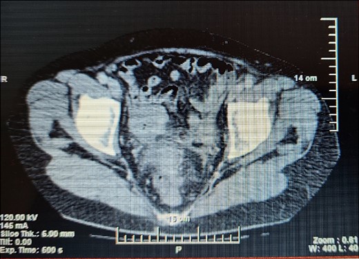 CT of the abdomen shows stenosing of the sigmoid colon.