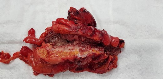 Macroscopic specimen after resection.