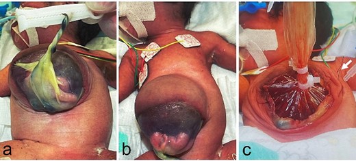 Physical findings at birth and at the primary surgery, day of Life 2; (a, b) prolapse of one-third of the liver and part of the small intestine is recognized in the omphalocele, and there is a ring-shaped defect in the rectus abdominis muscle; (c) the wound retractor is sutured to the muscle layer and the skin in four places (white arrow: suture).