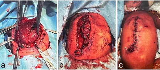 Operative findings at the second surgery, day of Life 6; (a–c) the subcutaneous tissues are sutured and the skin is closed.