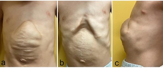 Physical findings before the third surgery, 6 years of age; (a–c) an abdominal incisional hernia measures 10 cm × 10 cm with a significant rectus abdominis muscle diastasis at the costal arch attachment point (a: during inspiration; b: during expiration; c: lateral view during inspiration).