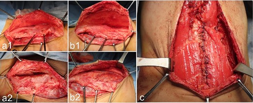 Operative findings at the third surgery: umbilical region; (a1, a2): the right external oblique muscle is cut vertically from the lower edge of the costal arch to the umbilicus at the lateral edge of the rectus abdominis muscle; (b1, b2) the left external oblique muscle is cut vertically, from the lower edge of the costal arch to the umbilicus at the lateral edge of the rectus abdominis muscle; (c) the rectus abdominis muscle is mobilized medially on both sides, and the medial edges are sutured together after making a U-shaped incision in the lower rectus abdominis fascia.