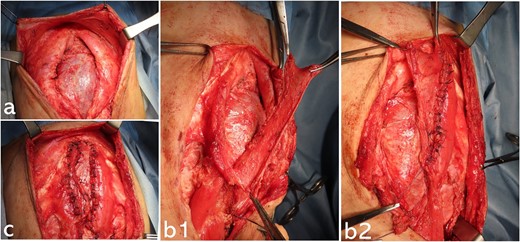 Operative findings at the third surgery: epigastric region; (a) there is a significant rectus abdominis muscle diastasis at the costal arch attachment point; part of the liver surface is covered with connective tissue; (b1, b2) the upper rectus abdominis muscle is peeled away from the costal arch attachment; the anterior aspect of the lower rectus abdominis sheath is cut using a U-shaped incision to be the same length as the epigastric defect; the fascia with the U-shaped incision is vertically inverted; the composite flap is made by suturing together the flap of the upper rectus muscle and the vertically inverted flap of the lower rectus fascia (b1: before suturing the composite flap on the right side; b2: after suturing the composite flap); (c) both composite flaps are reversed in the midline and sutured together, covering the epigastric muscular defect.