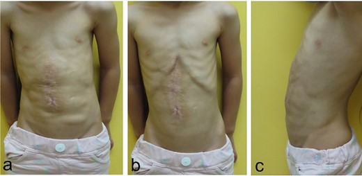 Physical findings on 5 months after the third surgery; (a–c) an abdominal incisional hernia develops no recurrent incisional hernia and no wound complications (a: during inspiration; b: during expiration; c: lateral view during inspiration).