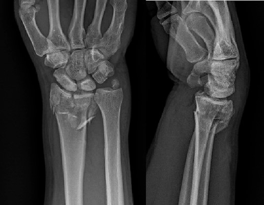 Preoperative radiological assessment of the patient with postero-anterior (PA) and lateral views of the right wrist.