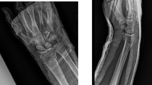 PA and lateral postsplint films.