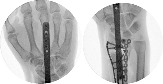 Intraoperative fluoroscopy with a PA view.