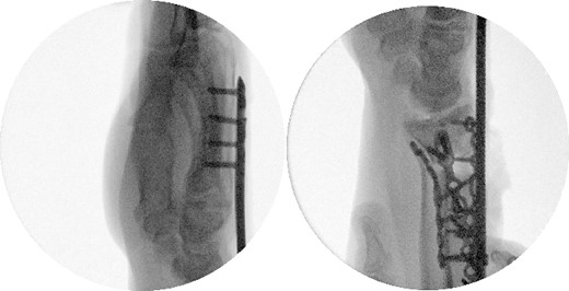 Intraoperative fluoroscopy with a lateral view.