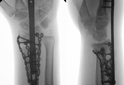 Radiological assessment at 2 months postprocedure with PA and lateral views.