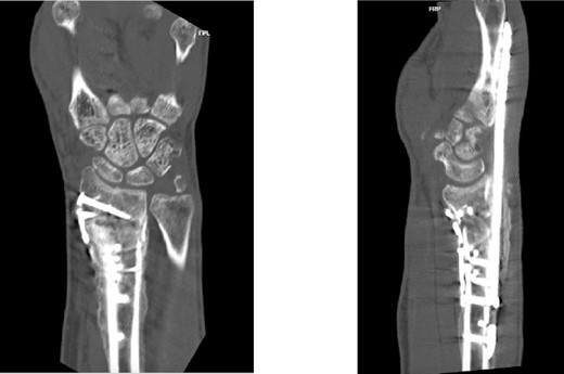 CT assessment at 10 weeks postprocedure with coronal and sagittal cuts.