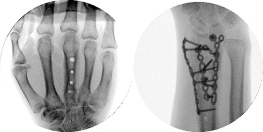 Dorsal spanning plate hardware removal at 4 months with a PA view.