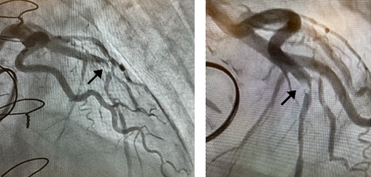 Coronary angiography detected 90% stenosis in the LAD artery; the arrow indicates the filling defect.