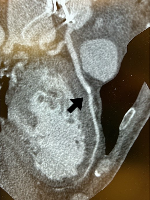 Coronary CT scans revealed a high-density area (arrow) in the LAD artery.