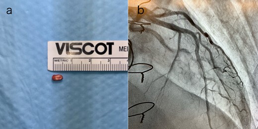 (a) The pledget was removed by transcatheter; (b) TIMI Grade 3 flow in the LAD artery after percutaneous coronary intervention.