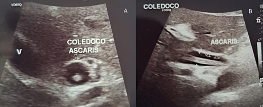 (A) Echography shows the bile duct dilated with the Ascaris inside it; (B) echography is a straight, non-shadowing echoic cord-like structure in the bile duct.