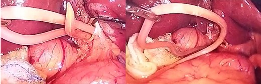 (A) The Ascaris is seen inside the bile duct; (B) the Ascaris is completely removed from the bile duct, choledochotomy is seen as well.