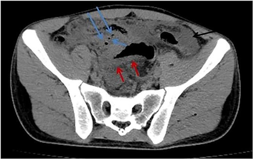 Axial abdomen CT scan without contrast shows pneumoperitoneum (blue arrows), free fluid (black arrow), and sigmoid wall thickening (red arrow).