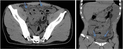 Axial (left) and coronal (right) views of abdomen CT scan without contrast show dirty fat planes closely related to the urinary bladder walls (mass formation).