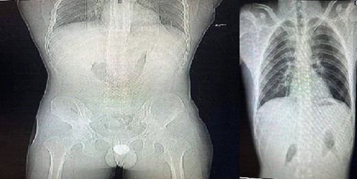 Standing abdominal X-ray and chest X-ray.
