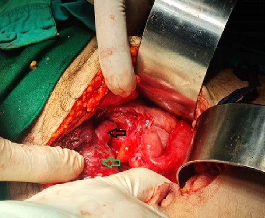 Intraoperative findings; black arrow: appendix, green arrow: urinary bladder.