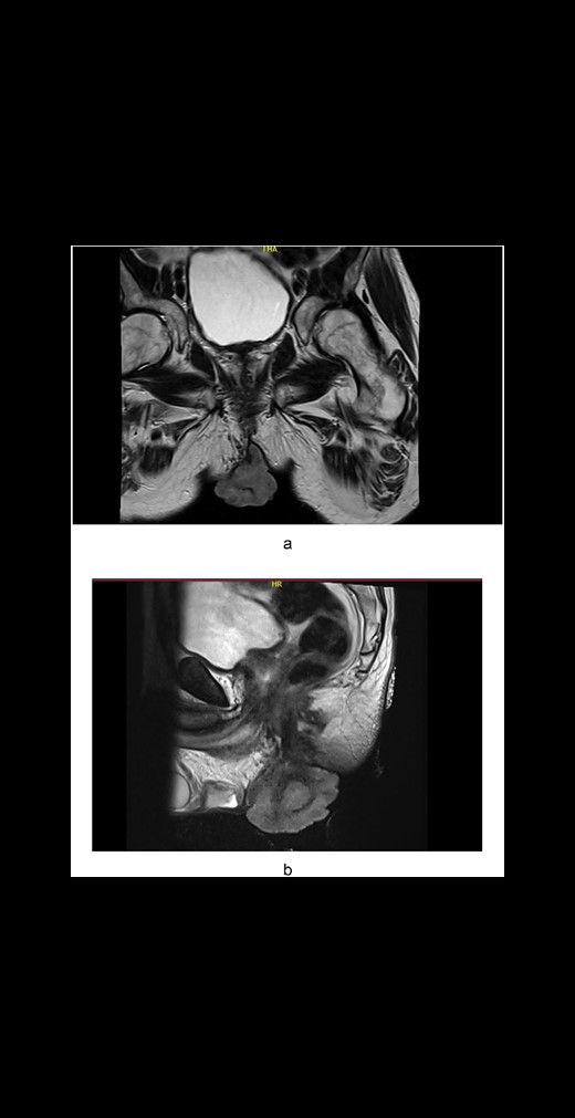 (a) Axial plane MRI pelvis: A large perianal mass. (b) Sagittal plane MRI pelvis: A large perianal mass