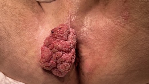 Perianal mass.