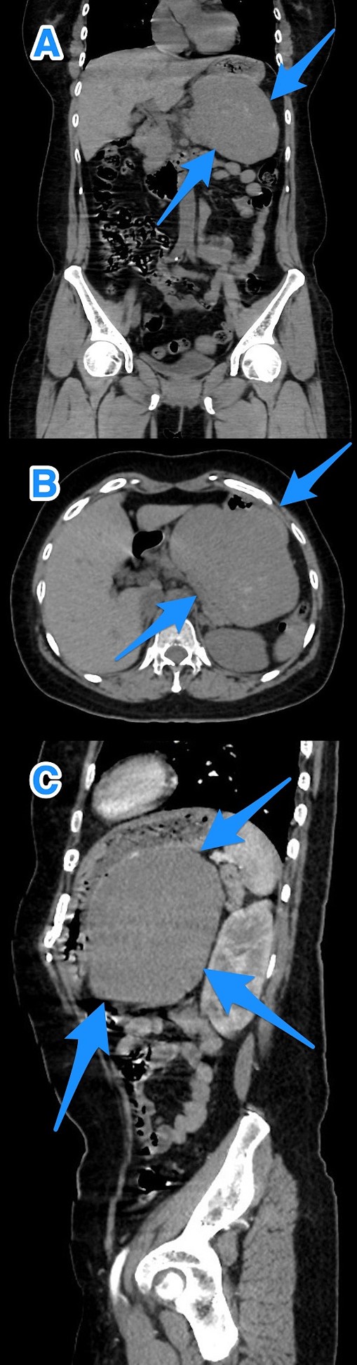 A multi-view computed tomography scan of the abdomen (A–C) showing a well-defined large gastric fundal/body submucosal heterogeneously hypoenhancing soft tissue mass lesion of the posterior gastric wall (arrows).