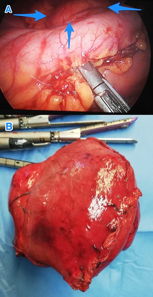 Intraoperative views of the gastric mass before (A) and after (B) resection (arrows).