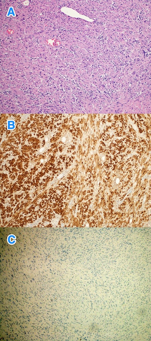 The histological sections of gastric mass show (A) a spindle cell tumor infiltrating through the gastric wall. The tumor cells are positive for S100 (B), while negative for (C) CD117, Dog-1, SMA, H-Caldesmon, Desmin, MSA, and B-Cahtenin (hematoxylin and eosin stain; 10x).
