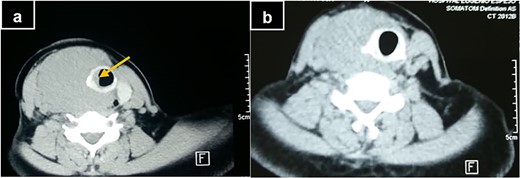 (a) Computerized tomography of the neck at diagnosis, showing tracheal invasion and deviation (yellow arrow). (b) Computerized tomography of the neck after the 4th R-CHOP cycle.
