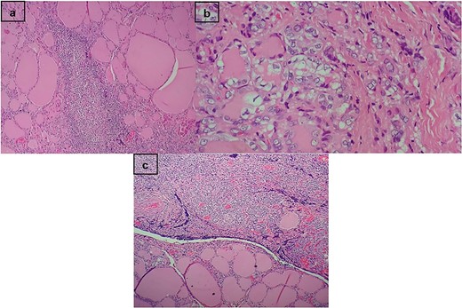 (a) Hashimoto’s thyroiditis. In the stroma, the presence of lymphoid follicles with germinal centers. (b) Follicular pattern papillary carcinoma. Empty nuclei, cleaved with bars and intranuclear inclusions. (c) Transition between the thyroid gland and dense proliferation of lymphocytes.