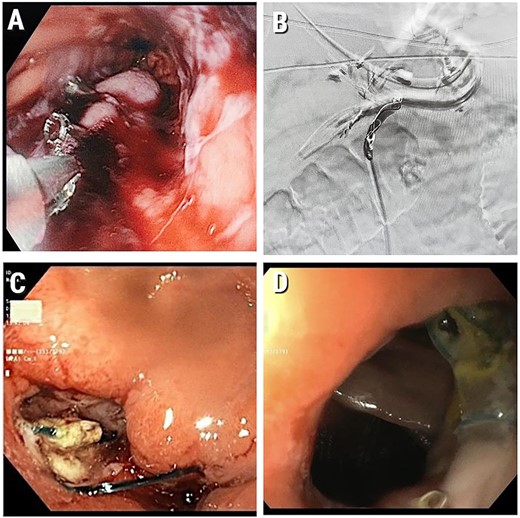 (A) Intraluminal gastric bleeding stopped with clipping at the stapler line; (B) Embolized LGA; (C) Gastroscopy at POD 25. A marginal ulcer with a clean base; (D) Healed marginal anastomotic ulcer (at gastroscopy 1.5 months post operation). We have obtained informed consent from patient to publish this manuscript.