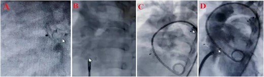 Treatment steps (A) close PDA by Amplatzer ADO II type AGA, size 5–6, (B) close ASD by Amplatzer Septal Oclotec size 15, (C) after closing PDA and ASD, D: close VSD by Amplatzer membranous, lifetec type symetric، size 12, (D) echocardiography four-chamber view after intervention.
