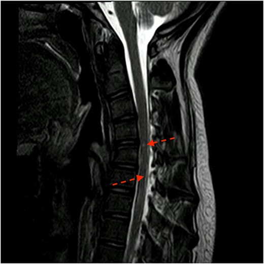Sagittal cut of MRI T2 sequence with evidence of medullary ischemic lesion in C5, and C6–C7 (arrows).