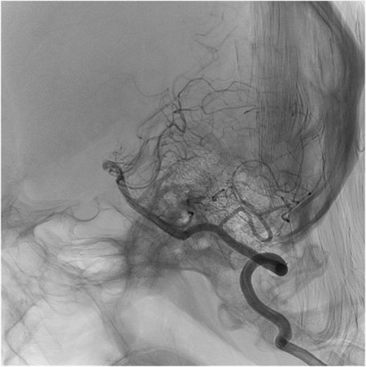 Sagittal cut of cerebral panangiography showing permeability of vertebral arteries.