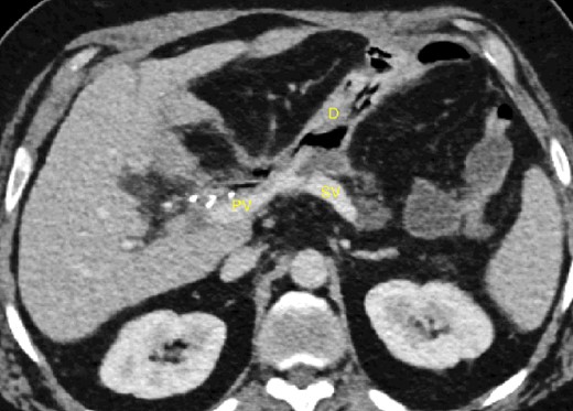 20-day post-operative CT scan showing irregularity of the splenic vein, without active bleeding. PV portal vein, SV splenic vein, D multi-tubular drain.
