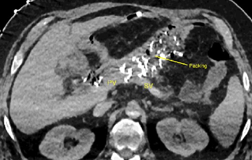 CT scan after relaparotomy located the packs used for hemorrhage control anterior to the confluence of the portal vein and splenic vein. PV portal vein, SV splenic vein.