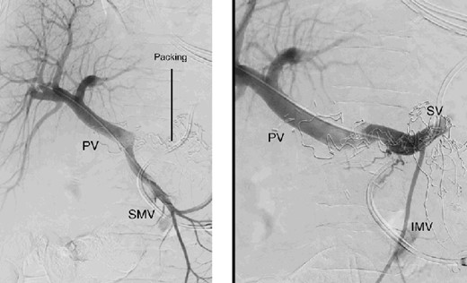 Percutaneous transhepatic portography with irregular aspect of the splenic vein behind the packs. PV portal vein, SMV superior mesenteric vein, SV splenic vein, IMV inferior mesenteric vein.