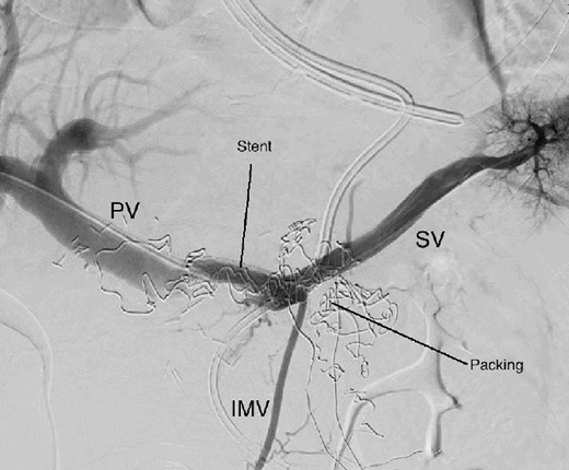 Percutaneous transhepatic portography after cover stent placement in the splenic vein behind the packs. PV portal vein, SV splenic vein, IMV inferior mesenteric vein.
