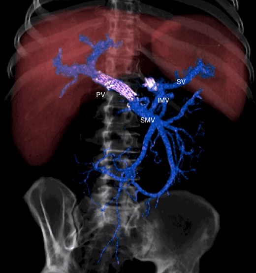 CT scan after other interventional radiology with plug in the splenic vein and cover stent in the superior mesenteric vein. PV portal vein, SMV superior mesenteric vein, SV splenic vein, IMV inferior mesenteric vein.