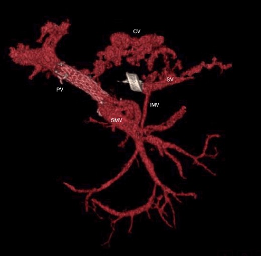 CT scan at 3 years, with development of venous collaterals that drain distal splenic vein and inferior mesenteric vein through the lesser omentum. PV portal vein, SMV superior mesenteric vein, SV splenic vein, IMV inferior mesenteric vein, CV collateral veins.
